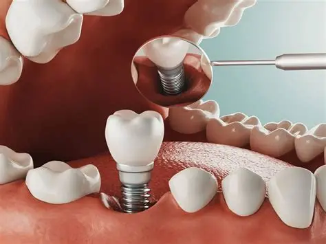 Dental implant example