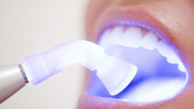 Laser Teeth Whitening