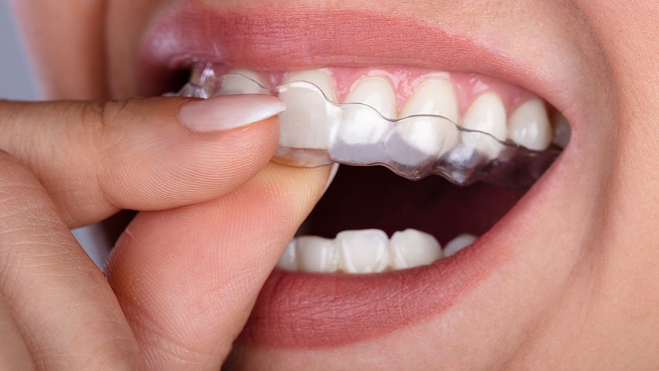 Comprehensive Aligners