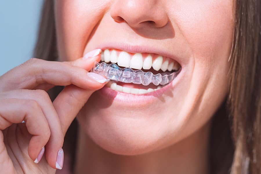 Express Aligners