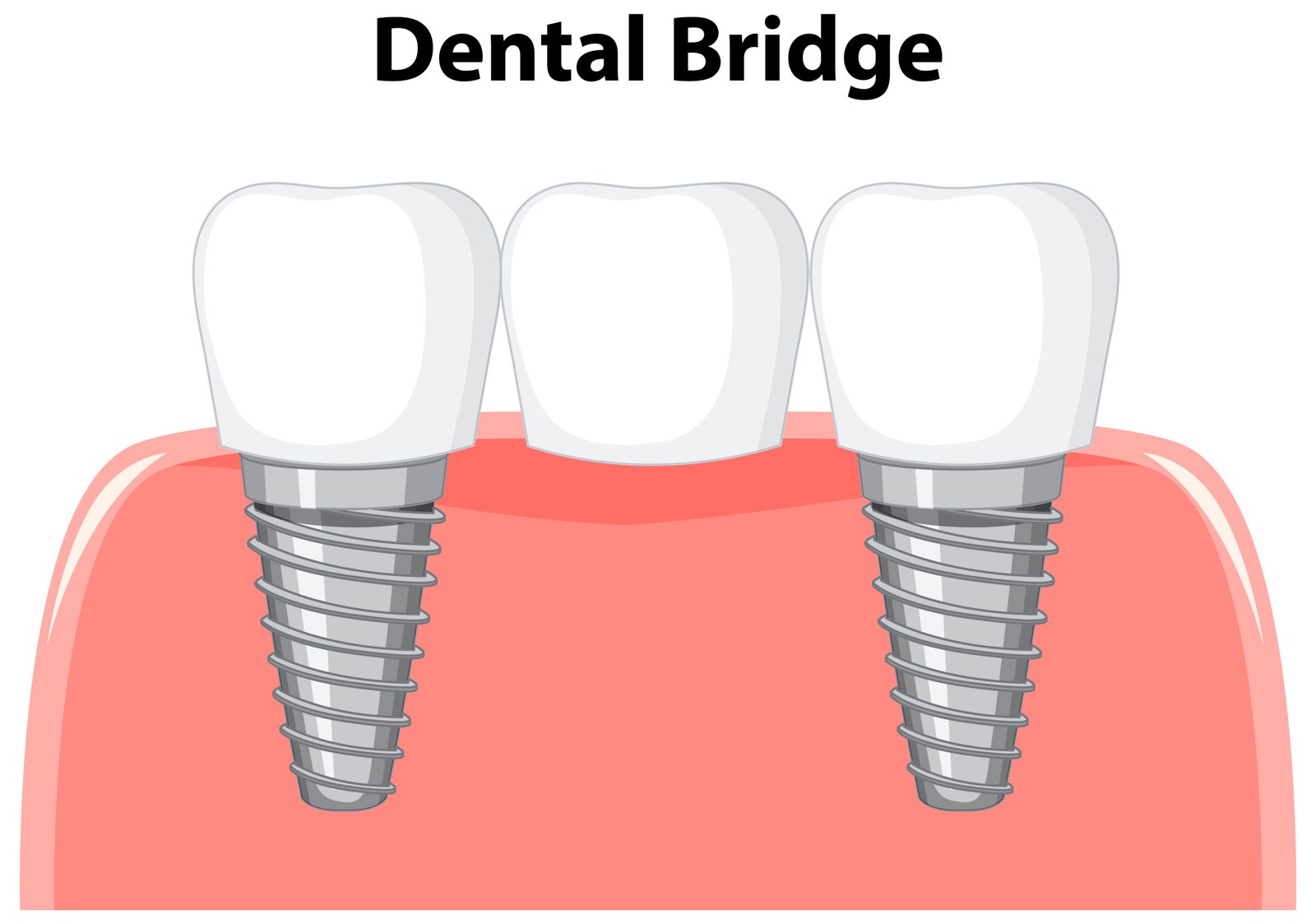 Implant Supported Bridge